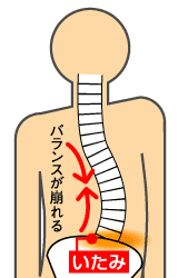 腰痛の症状／背筋のバランスが崩れる